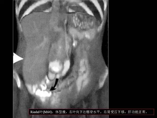 【PPT】肝脏解剖与常见变异
