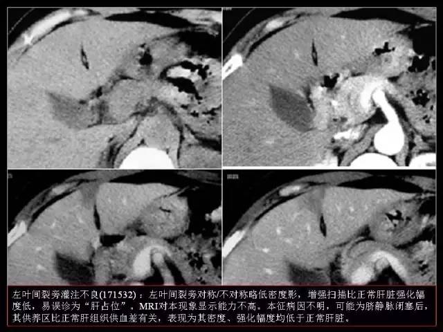 【PPT】肝脏解剖与常见变异