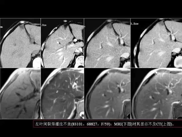 【PPT】肝脏解剖与常见变异