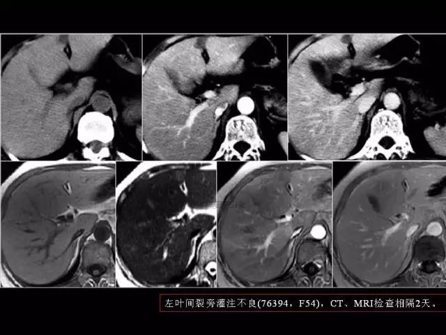 【PPT】肝脏解剖与常见变异