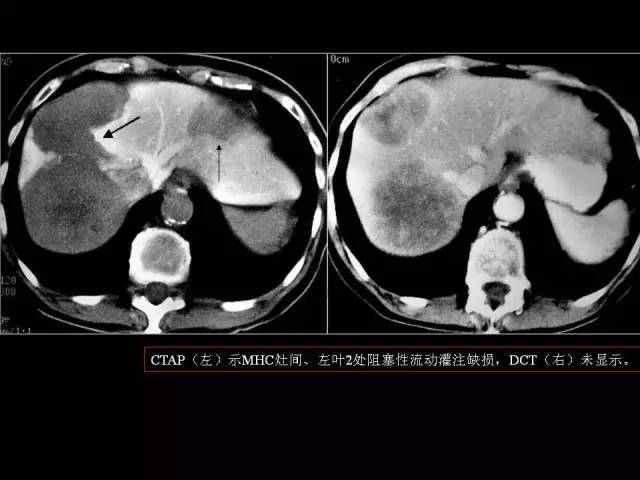 【PPT】肝脏解剖与常见变异