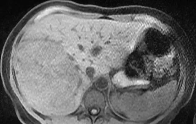 【病例】肝脏腺瘤3例影像学解析