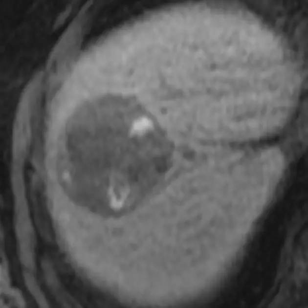 【病例】肝脏腺瘤3例影像学解析
