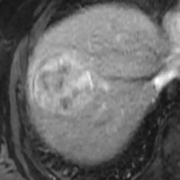 【病例】肝脏腺瘤3例影像学解析