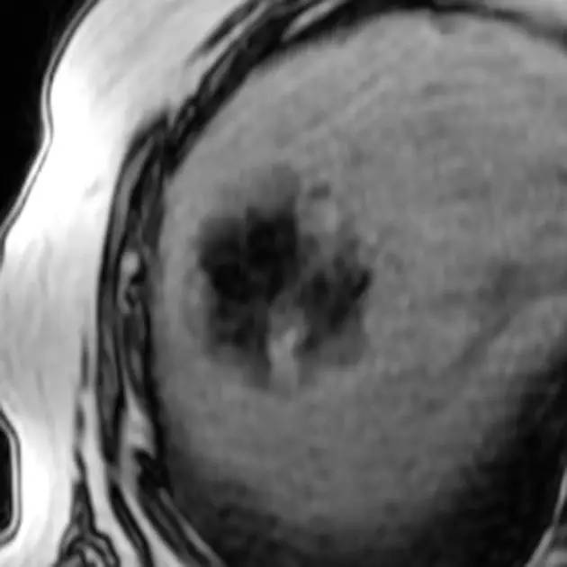【病例】肝脏腺瘤3例影像学解析
