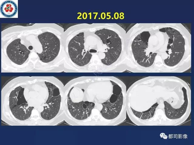【PPT】肺淋巴管肌瘤病影像诊断