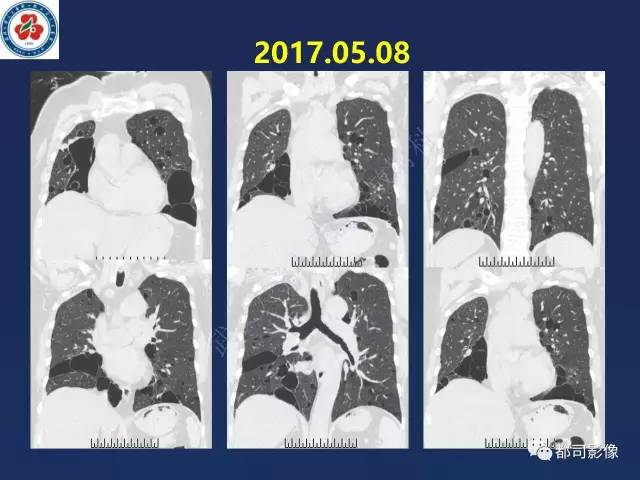 【PPT】肺淋巴管肌瘤病影像诊断