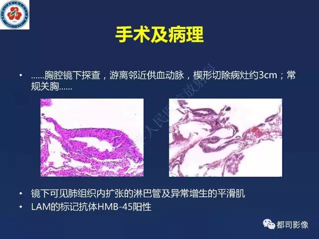 【PPT】肺淋巴管肌瘤病影像诊断