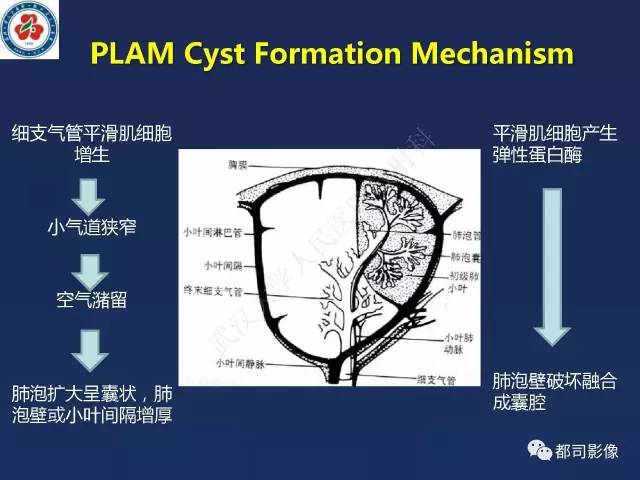 【PPT】肺淋巴管肌瘤病影像诊断