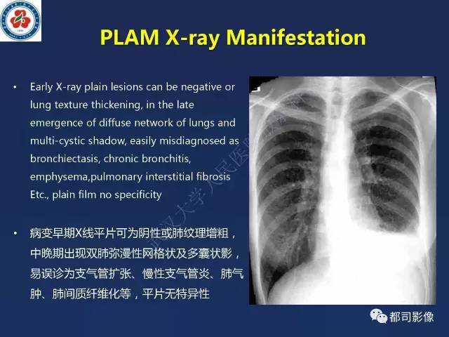【PPT】肺淋巴管肌瘤病影像诊断