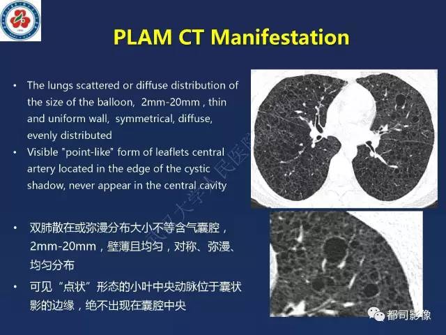 【PPT】肺淋巴管肌瘤病影像诊断
