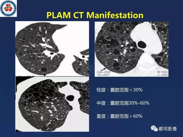 【PPT】肺淋巴管肌瘤病影像诊断