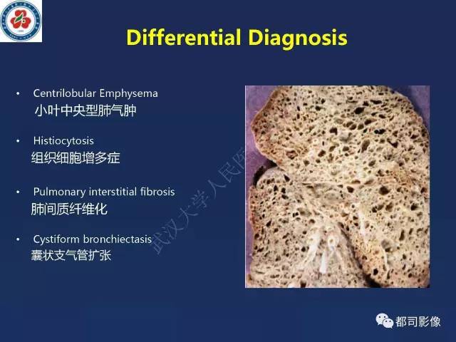 【PPT】肺淋巴管肌瘤病影像诊断