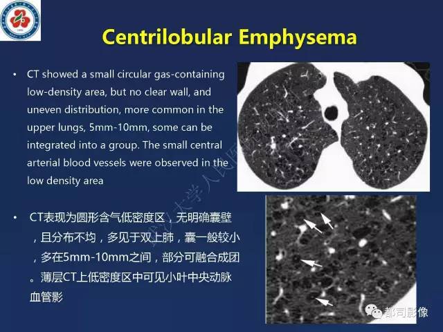 【PPT】肺淋巴管肌瘤病影像诊断