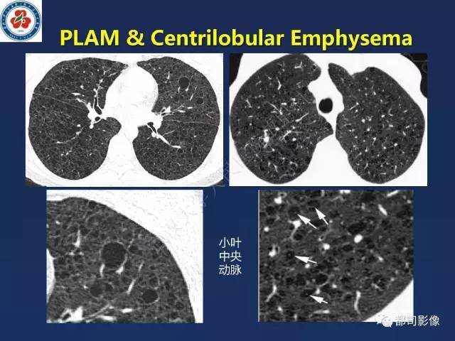 【PPT】肺淋巴管肌瘤病影像诊断