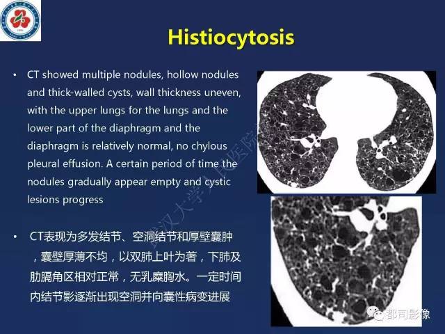 【PPT】肺淋巴管肌瘤病影像诊断
