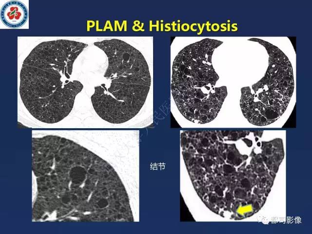 【PPT】肺淋巴管肌瘤病影像诊断