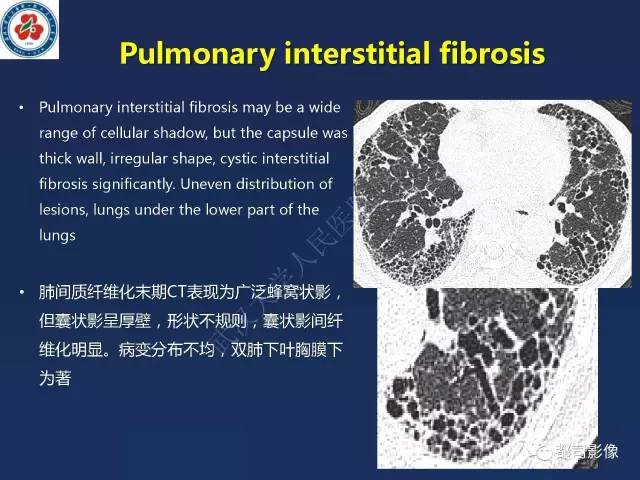 【PPT】肺淋巴管肌瘤病影像诊断