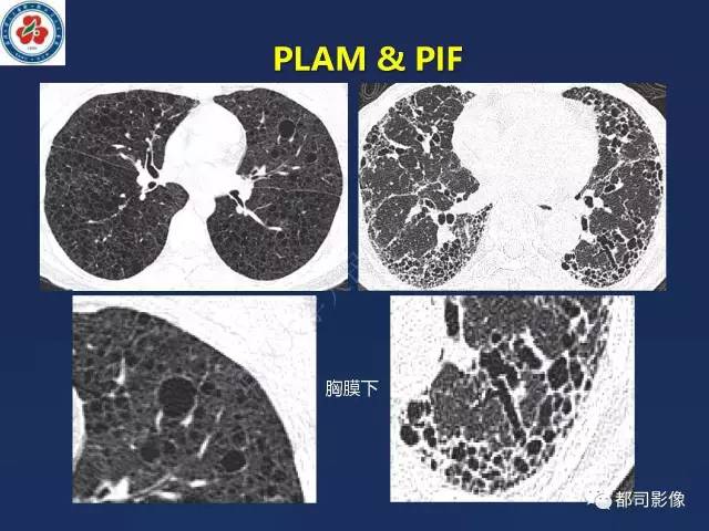 【PPT】肺淋巴管肌瘤病影像诊断
