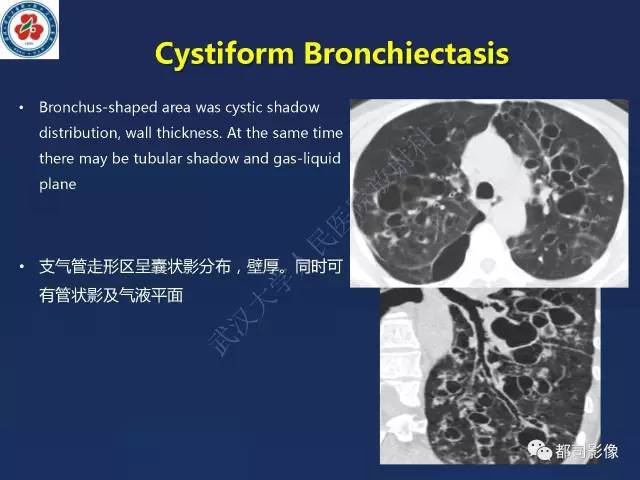 【PPT】肺淋巴管肌瘤病影像诊断