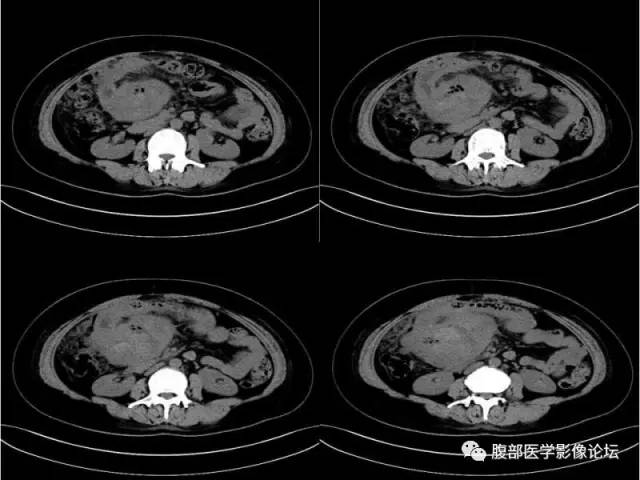 【病例】胃肠道间质瘤1例CT影像表现