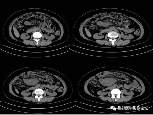 【病例】胃肠道间质瘤1例CT影像表现