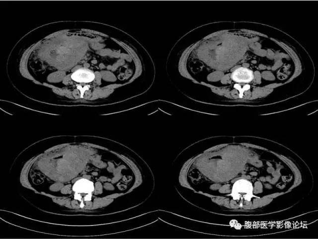 【病例】胃肠道间质瘤1例CT影像表现
