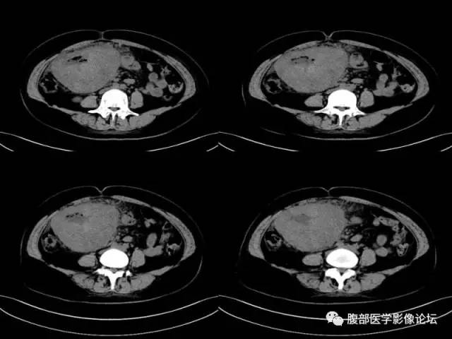 【病例】胃肠道间质瘤1例CT影像表现