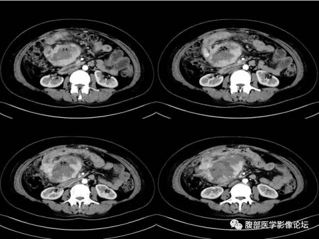【病例】胃肠道间质瘤1例CT影像表现