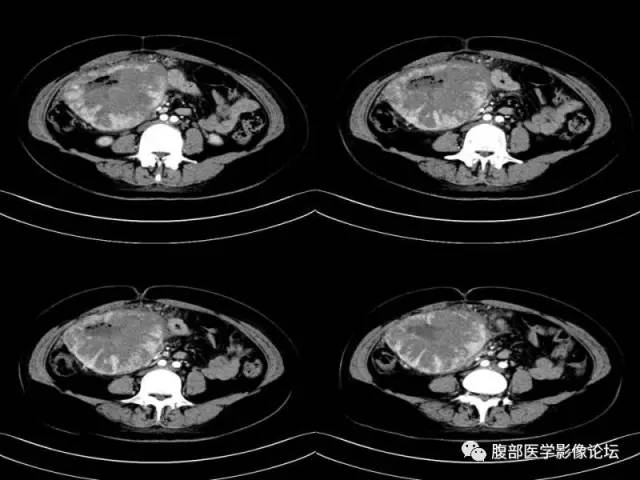 【病例】胃肠道间质瘤1例CT影像表现
