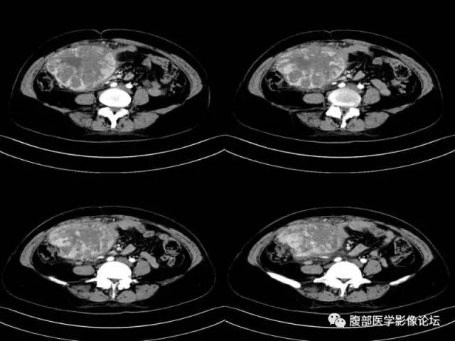 【病例】胃肠道间质瘤1例CT影像表现