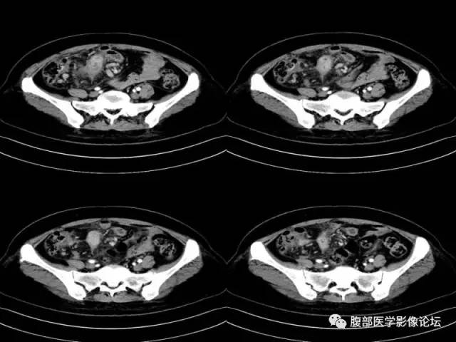 【病例】胃肠道间质瘤1例CT影像表现