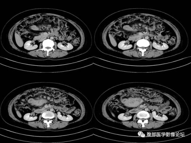 【病例】胃肠道间质瘤1例CT影像表现