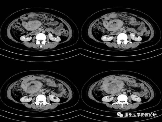 【病例】胃肠道间质瘤1例CT影像表现