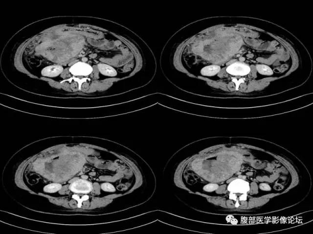 【病例】胃肠道间质瘤1例CT影像表现