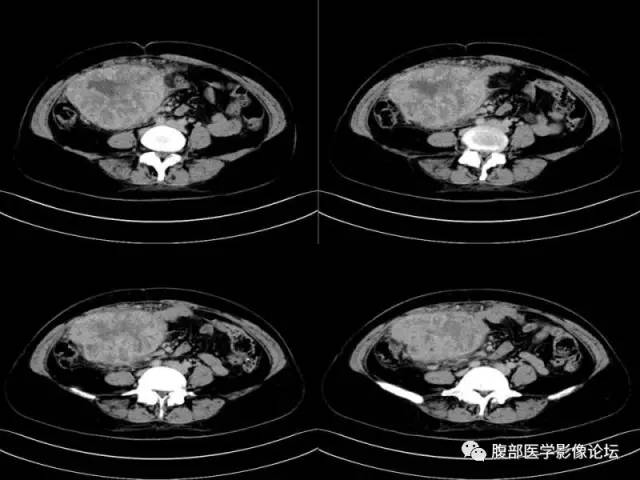 【病例】胃肠道间质瘤1例CT影像表现