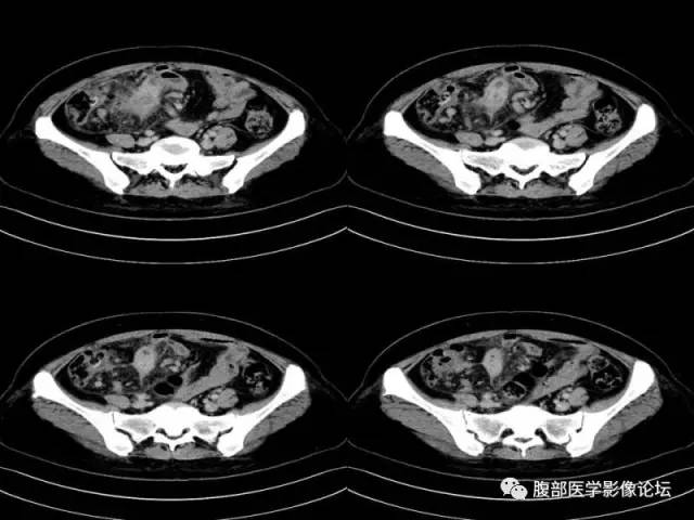 【病例】胃肠道间质瘤1例CT影像表现