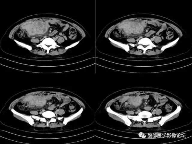 【病例】胃肠道间质瘤1例CT影像表现