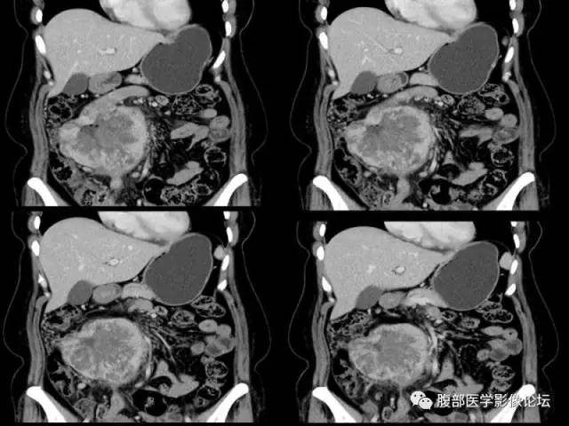 【病例】胃肠道间质瘤1例CT影像表现