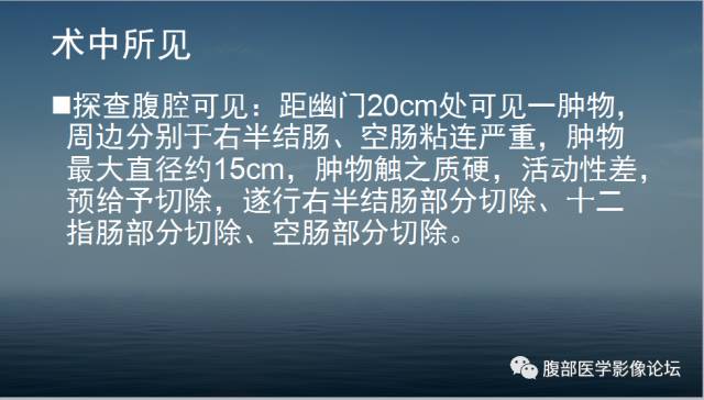 【病例】胃肠道间质瘤1例CT影像表现