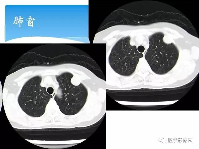 【病例】肺孤立性纤维瘤1例CT影像表现 【病例】肺孤立性纤维瘤1例CT影像表现
