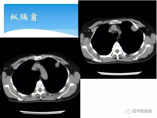 【病例】肺孤立性纤维瘤1例CT影像表现 【病例】肺孤立性纤维瘤1例CT影像表现