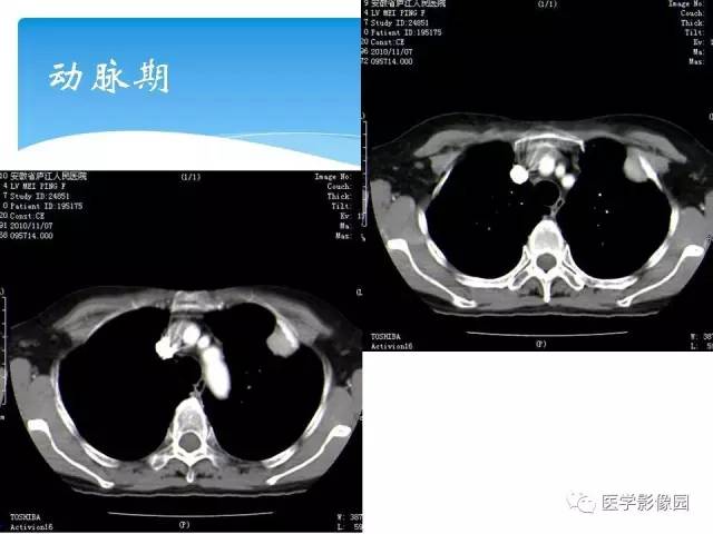 【病例】肺孤立性纤维瘤1例CT影像表现 【病例】肺孤立性纤维瘤1例CT影像表现