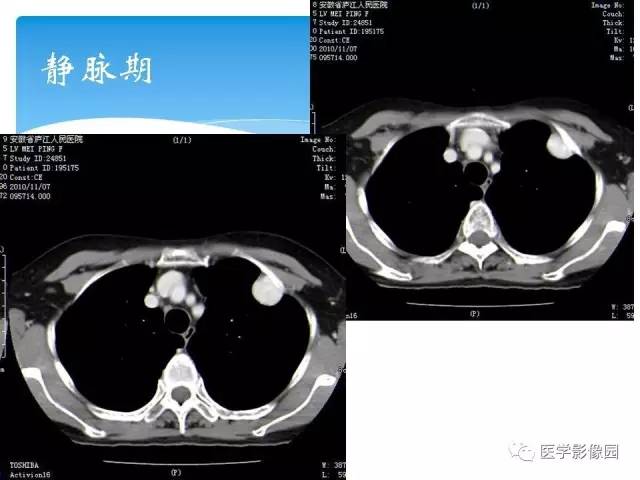 【病例】肺孤立性纤维瘤1例CT影像表现