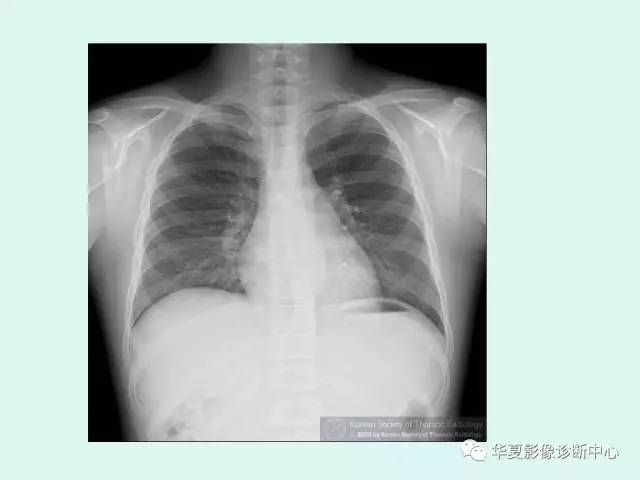 【病例】神经节细胞瘤一例CT及MR