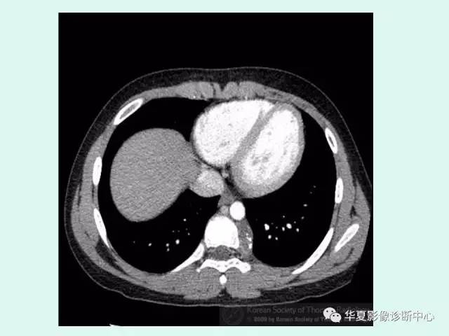 【病例】神经节细胞瘤一例CT及MR