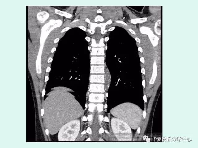 【病例】神经节细胞瘤一例CT及MR