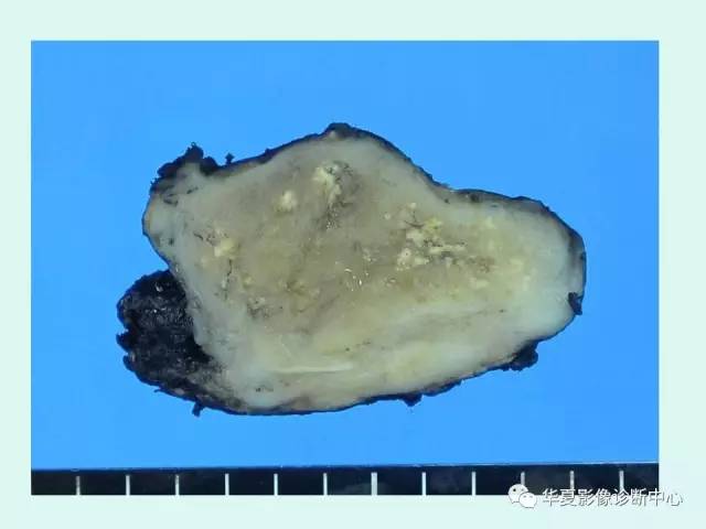 【病例】神经节细胞瘤一例CT及MR
