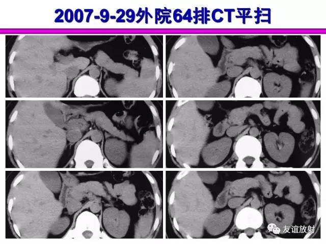【PPT】胰腺神经内分泌肿瘤(pNet)的CT、MRI检查与诊断