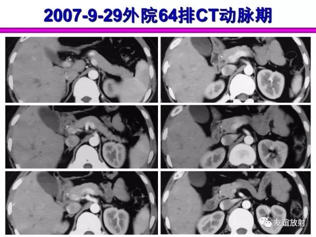 【PPT】胰腺神经内分泌肿瘤(pNet)的CT、MRI检查与诊断